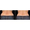 Coolsculpting B&A