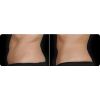 Coolsculpting B&A