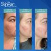 SkinPen® Microneedling