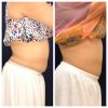 emsculpt_emsculpt_66293