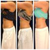 emsculpt_emsculpt_66295