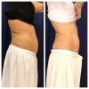 emsculpt_emsculpt_66299