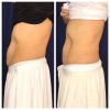 emsculpt_emsculpt_66303