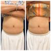 emsculpt_emsculpt_66304