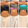 emsculpt_emsculpt_66309