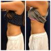 emsculpt_emsculpt_66314