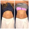 emsculpt_emsculpt_66317