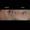 Exilis Ultra™ Treatment - Face & Neck