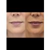 filler-lips-kysse_filler_66176