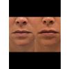 filler-lips-kysse_filler_66177