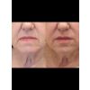 filler-lips-kysse_filler_66178