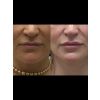 filler-lips-kysse_filler_66179