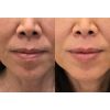 filler-lips-kysse_filler_66180