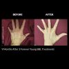 Forever Young BBL Before and After Nine