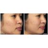 Fraxel B&A5