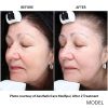 Halo™ Hybrid Fractional Laser (12 options)