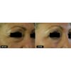 Fractional Laser Skin Resurfacing Fraxel 1540 Before & After