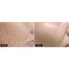 Fractional Laser Skin Resurfacing Fraxel 1540 Before & After