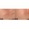 Fractional Laser Skin Resurfacing Fraxel 1540 Before & After