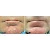Fractional Laser Skin Resurfacing Fraxel 1540 Before & After
