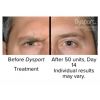 Dysport® by the Unit