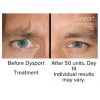 Dysport® by the Unit