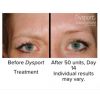 Dysport® by the Unit