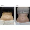 Futura Fit Program™ - Non-Surgical Fat Reduction and Inch Loss