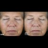 Skinbetter Science Instant Effect Gel EYE Before and After