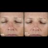 Skinbetter Science Instant Effect Gel EYE Before and After