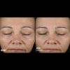 Skinbetter Science Instant Effect Gel EYE Before and After