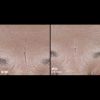 Skinbetter Science® Interfuse® Treatment Face & Neck Cream Before & After