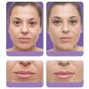 Juvederm - Jennifer