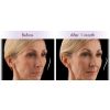 Juvederm Voluma XC Tami