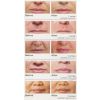 JUVÉDERM® Ultra Plus XC NOBD