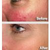 Laser Genesis before and after