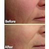 Laser Genesis before and after