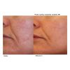 Laser Genesis before and after