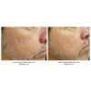 Laser Genesis before and after