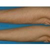 Laser Hair Removal - ArmsHands