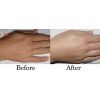 Laser Hair Removal - ArmsHands