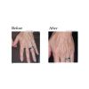 Limelight IPL before and after