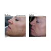 Limelight IPL before and after