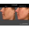 Limelight IPL before and after