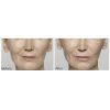 Restylane®  Lyft before and after