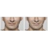 Restylane®  Lyft before and after
