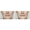 Restylane®  Lyft before and after