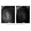 PRP Hair Restoration