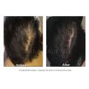 PRP Hair Restoration