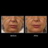 OxyGeneo® 3-in-1 Super Facial 